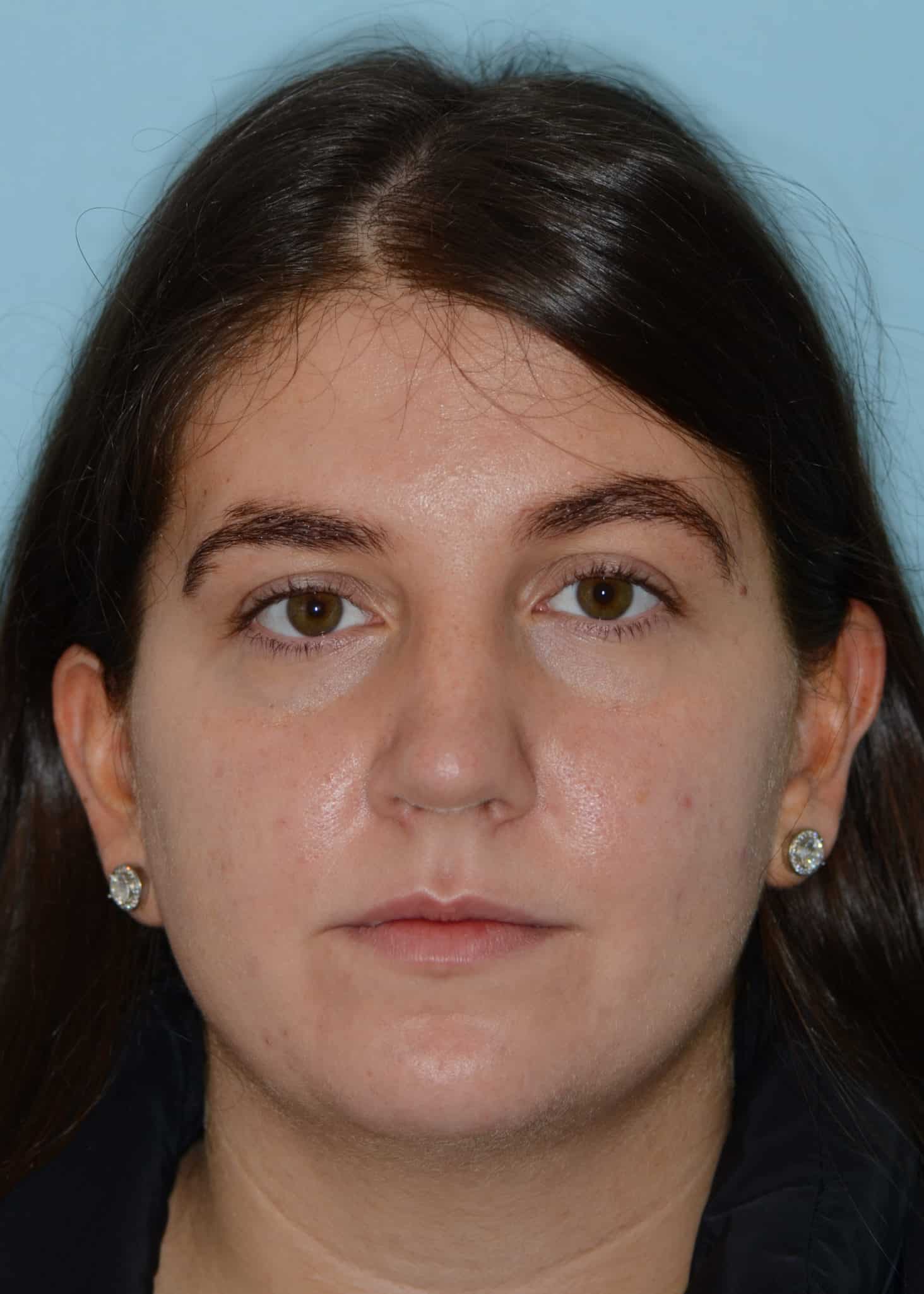 Rhinoplasty William D. Losquadro, MD Facial Plastic