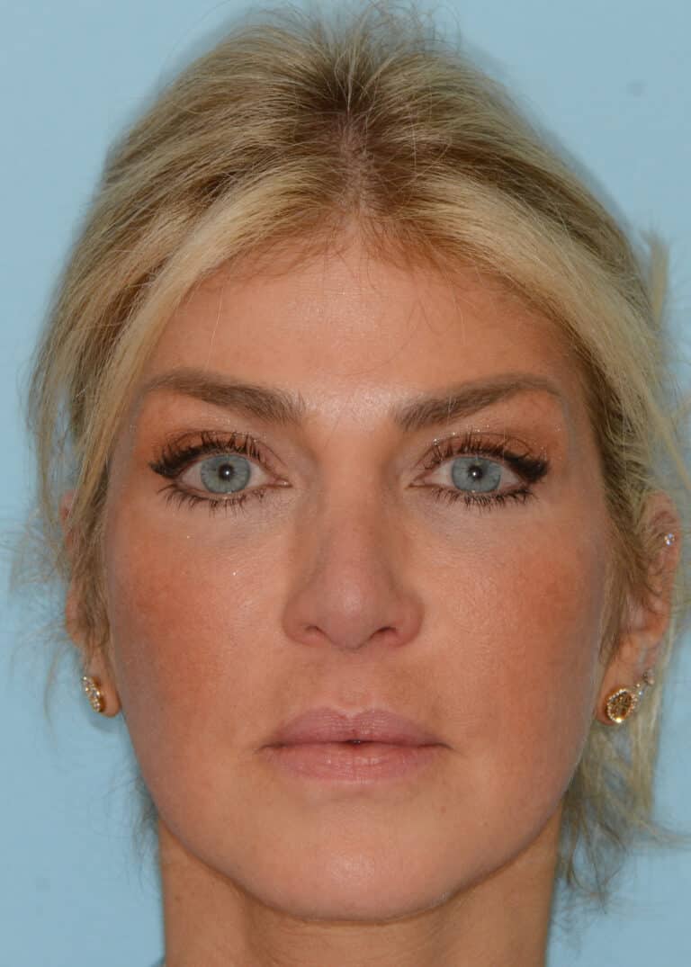 Before Image:  - front