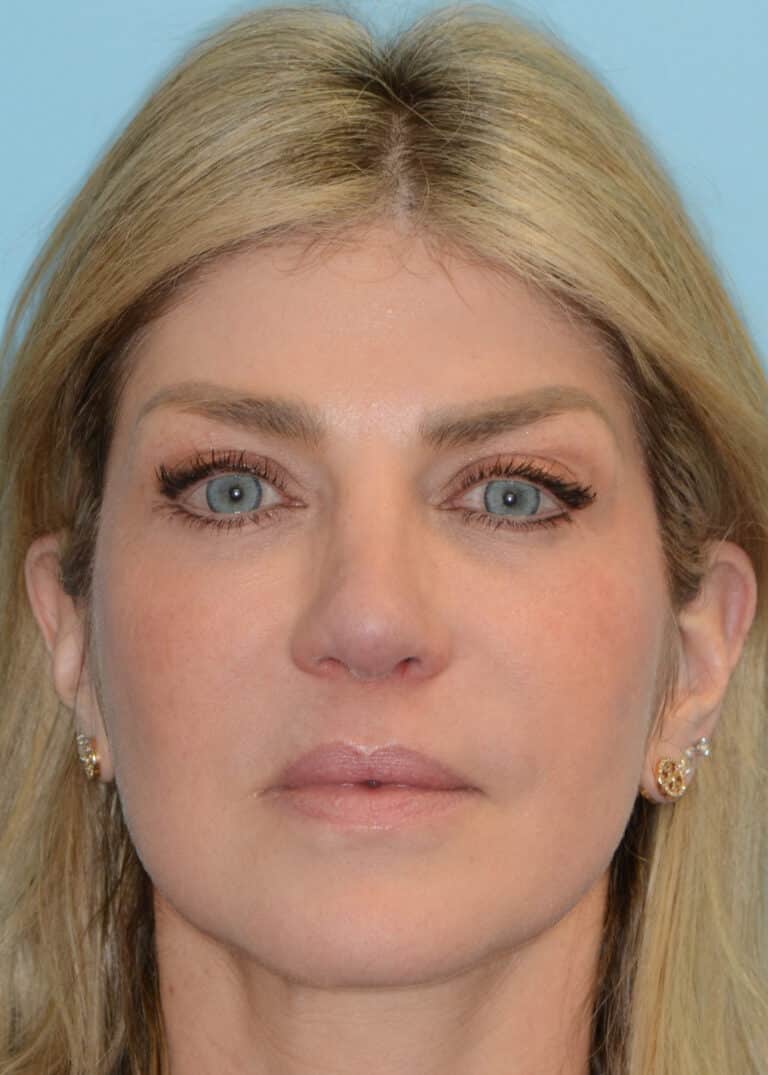 After Image:  - front
