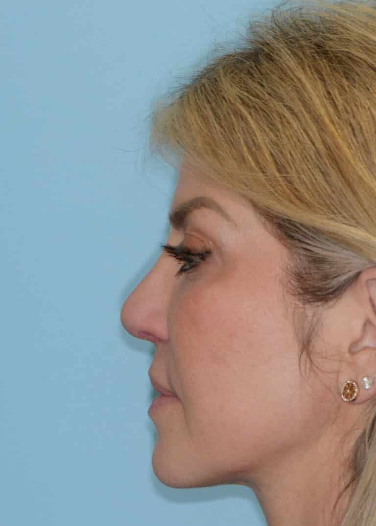 After Image:  - left-side