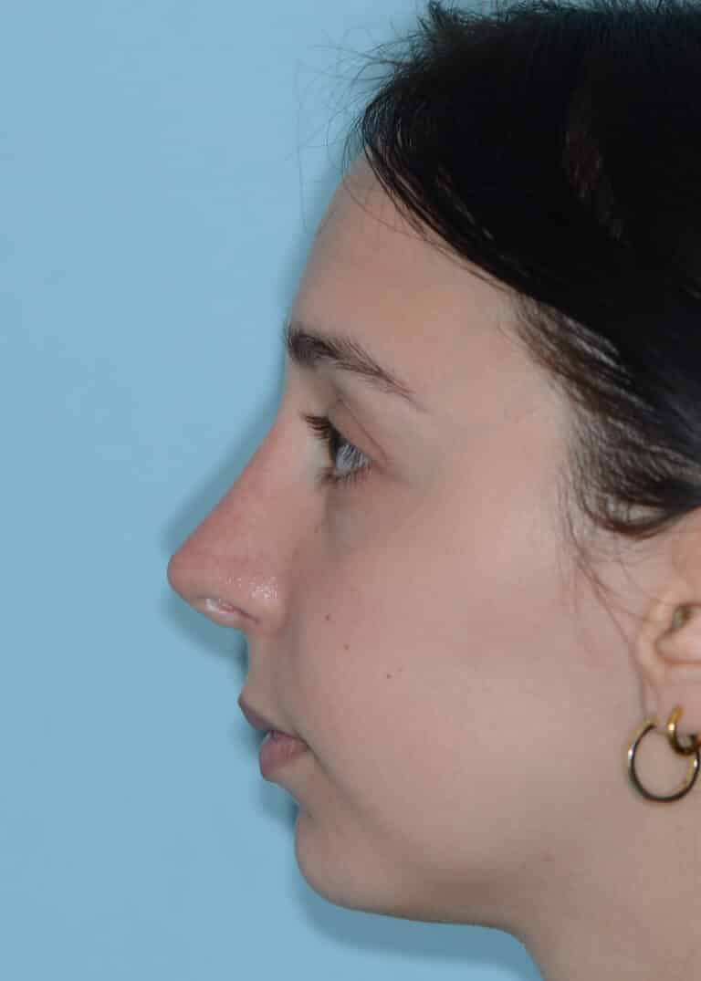 After Image:  - left-side