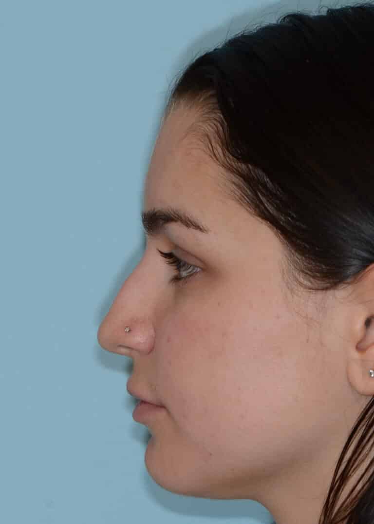 Before Image:  - left-side