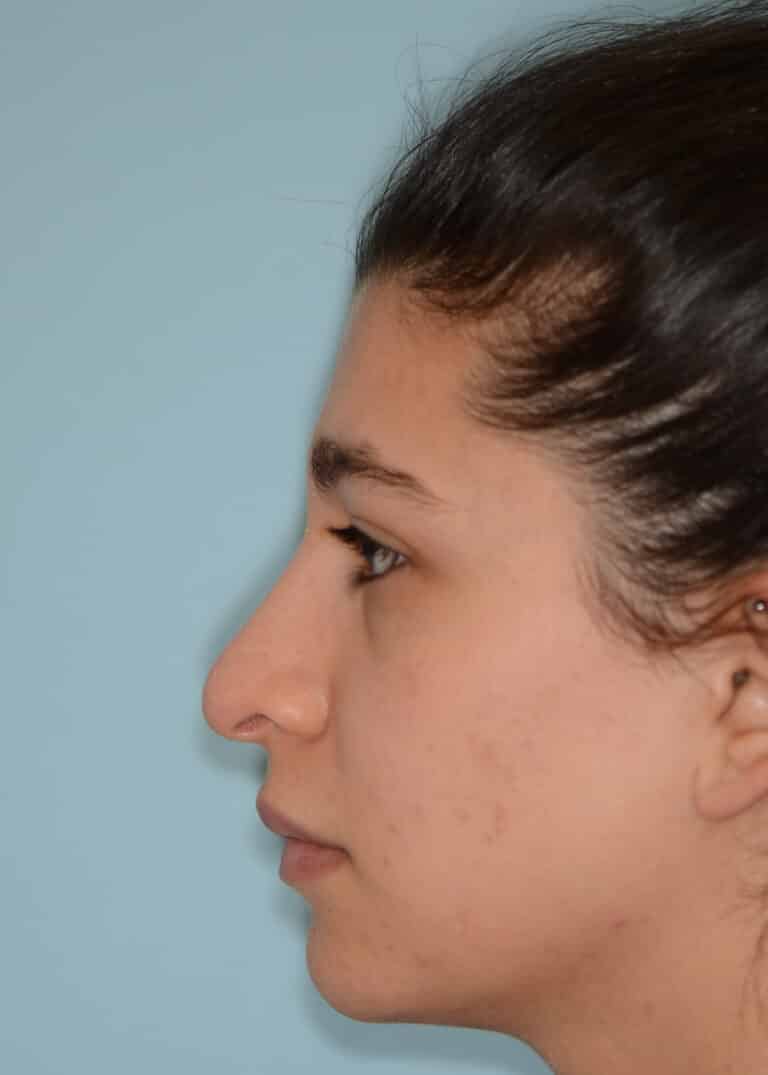 Before Image:  - left-side