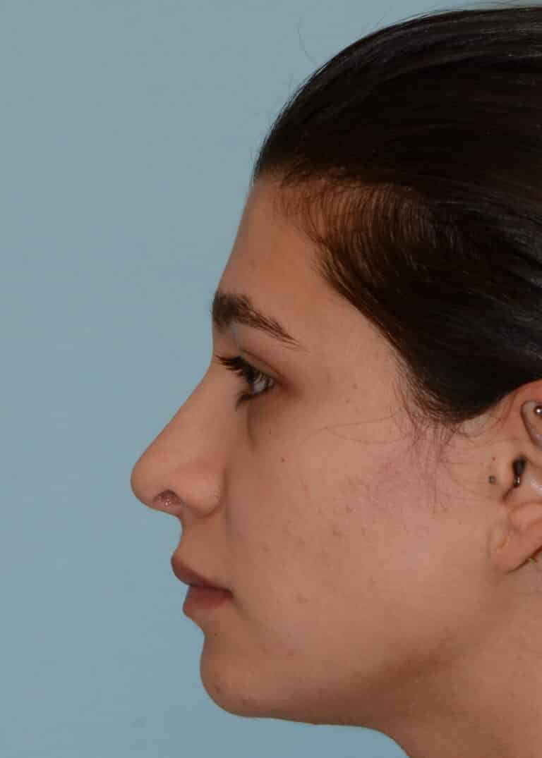 After Image:  - left-side