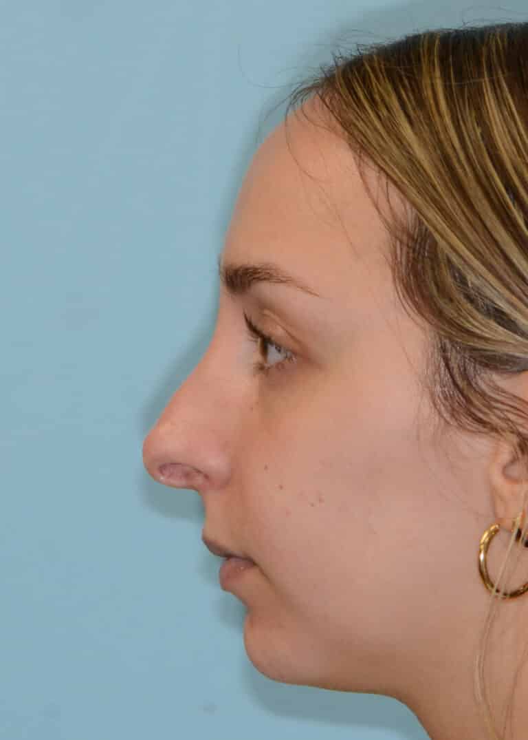 Before Image:  - left-side