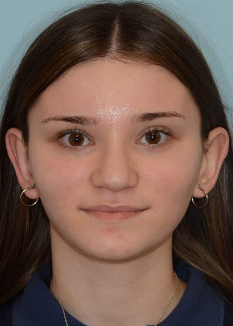 After Image:  - front