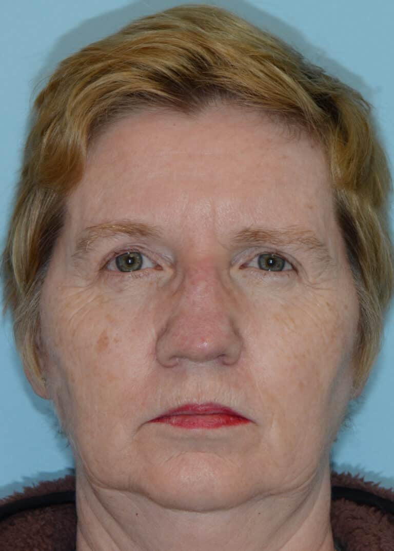 Before Image:  - front