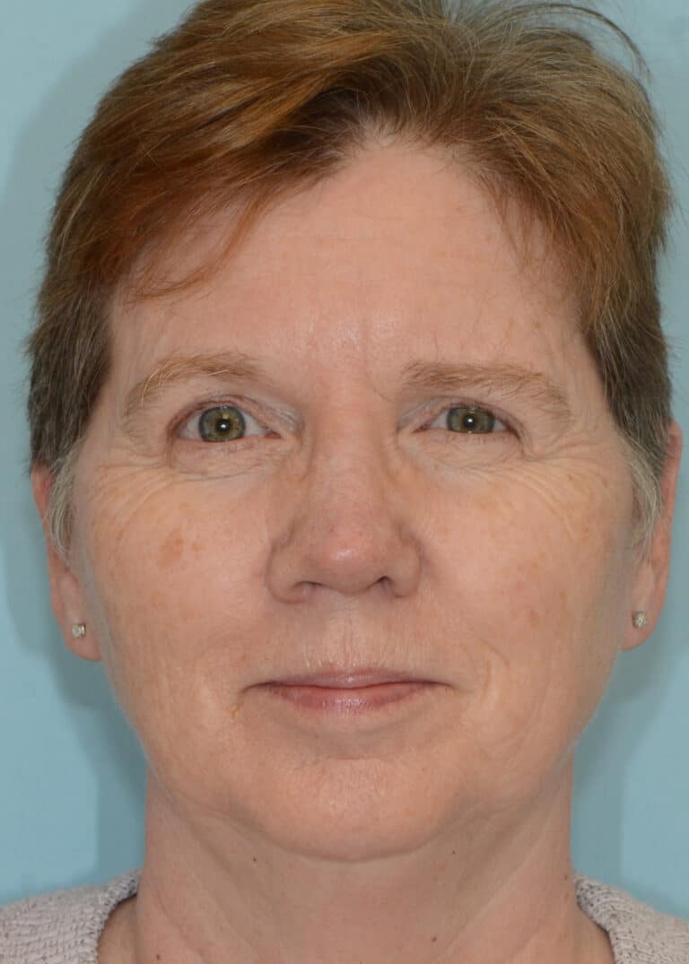 After Image:  - front