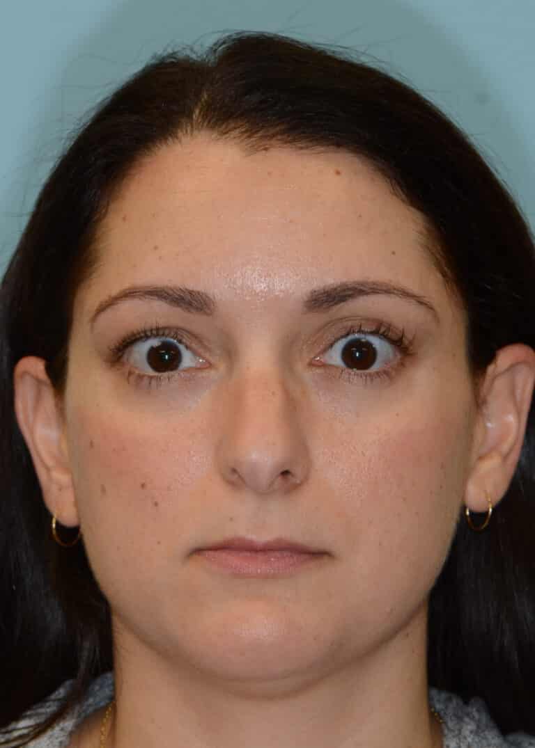 Before Image:  - front