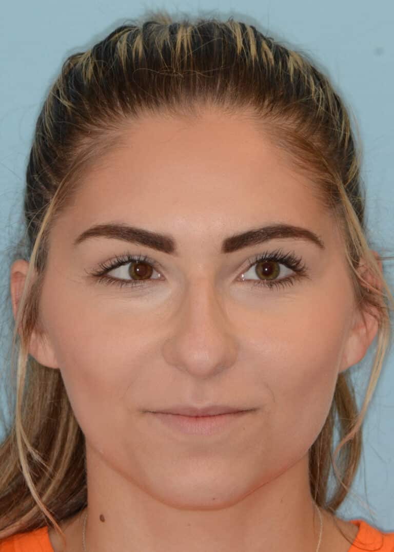 Before Image:  - front