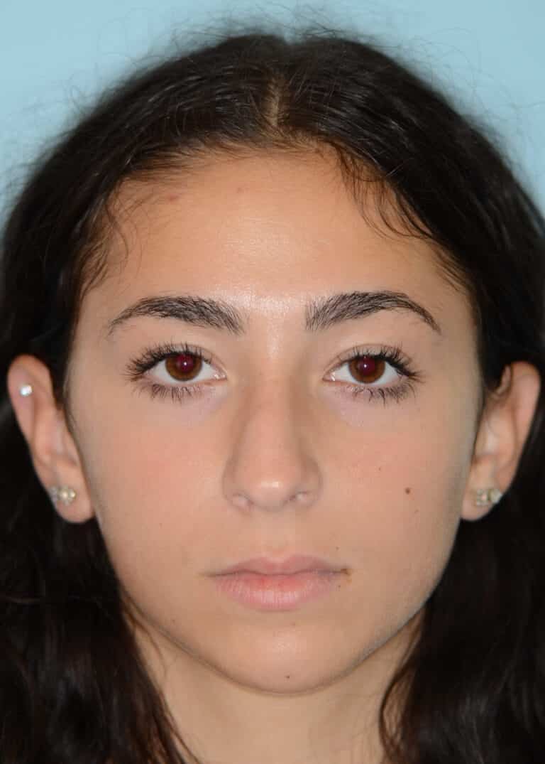 Before Image:  - front