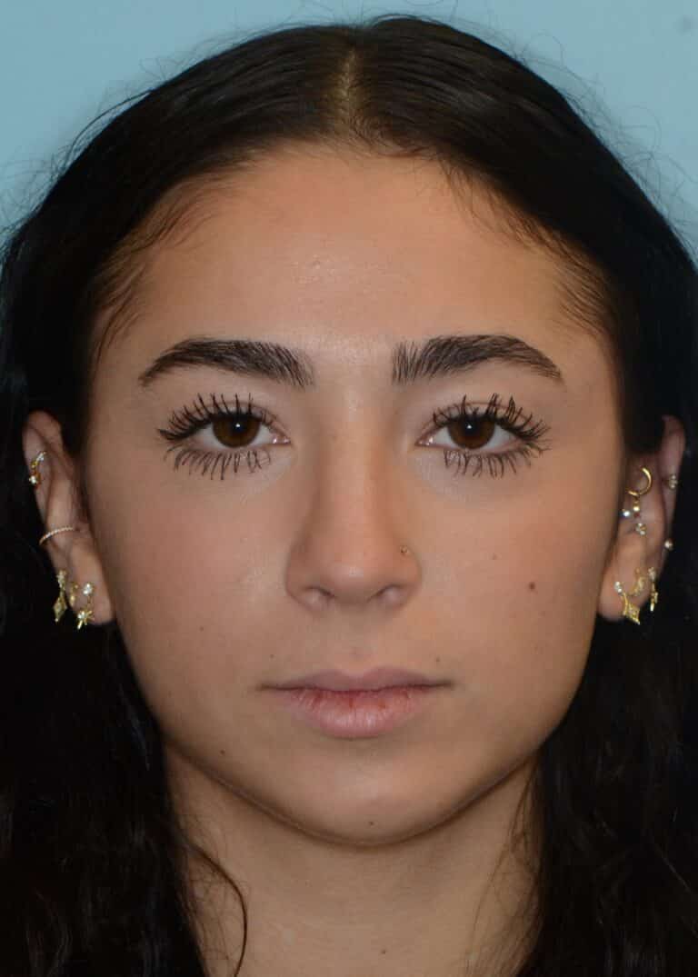 After Image:  - front