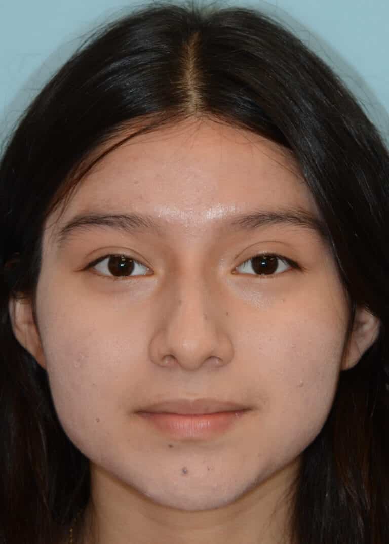 Before Image:  - front