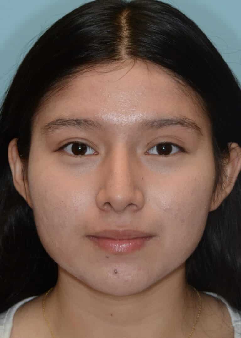 After Image:  - front