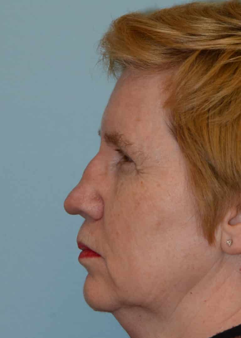 Before Image:  - left-side