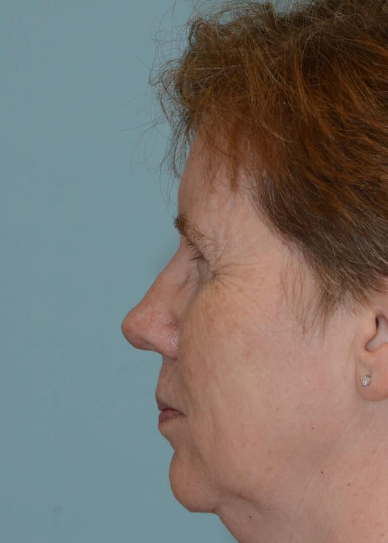 After Image:  - left-side