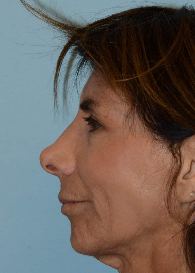 Before Image:  - left-side