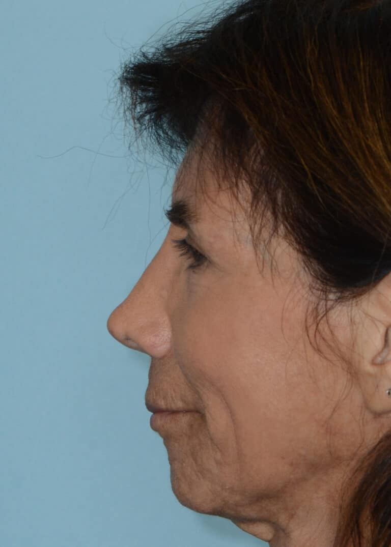 After Image:  - left-side