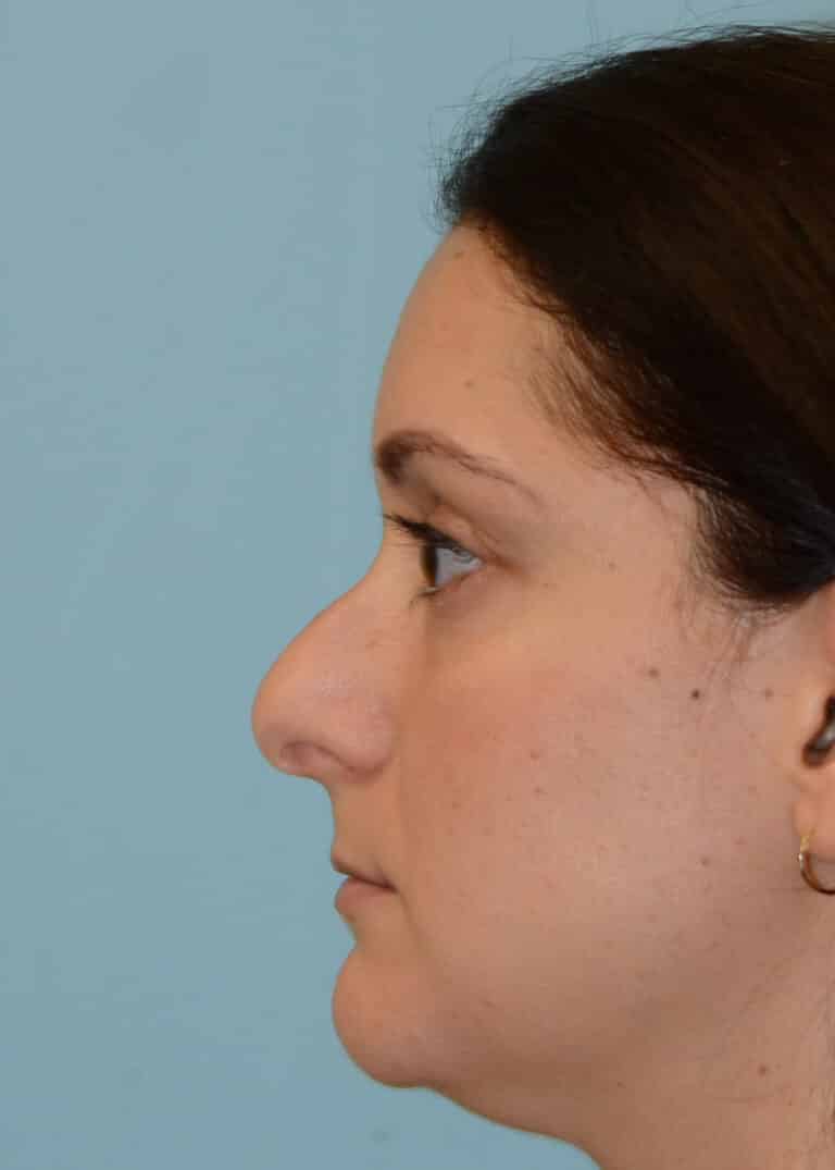 Before Image:  - left-side