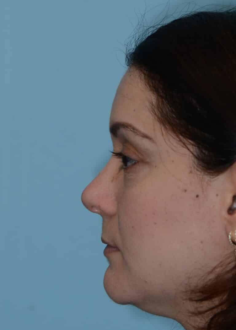 After Image:  - left-side