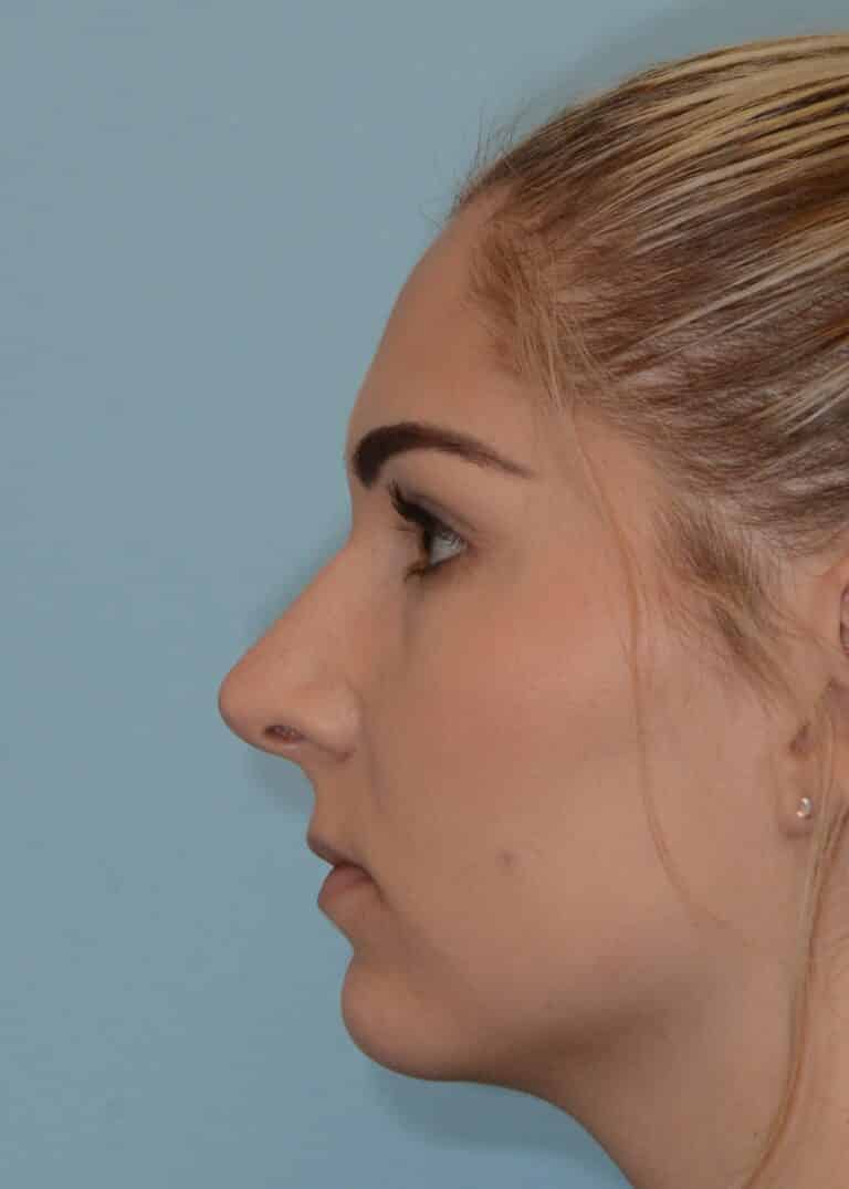 After Image:  - left-side
