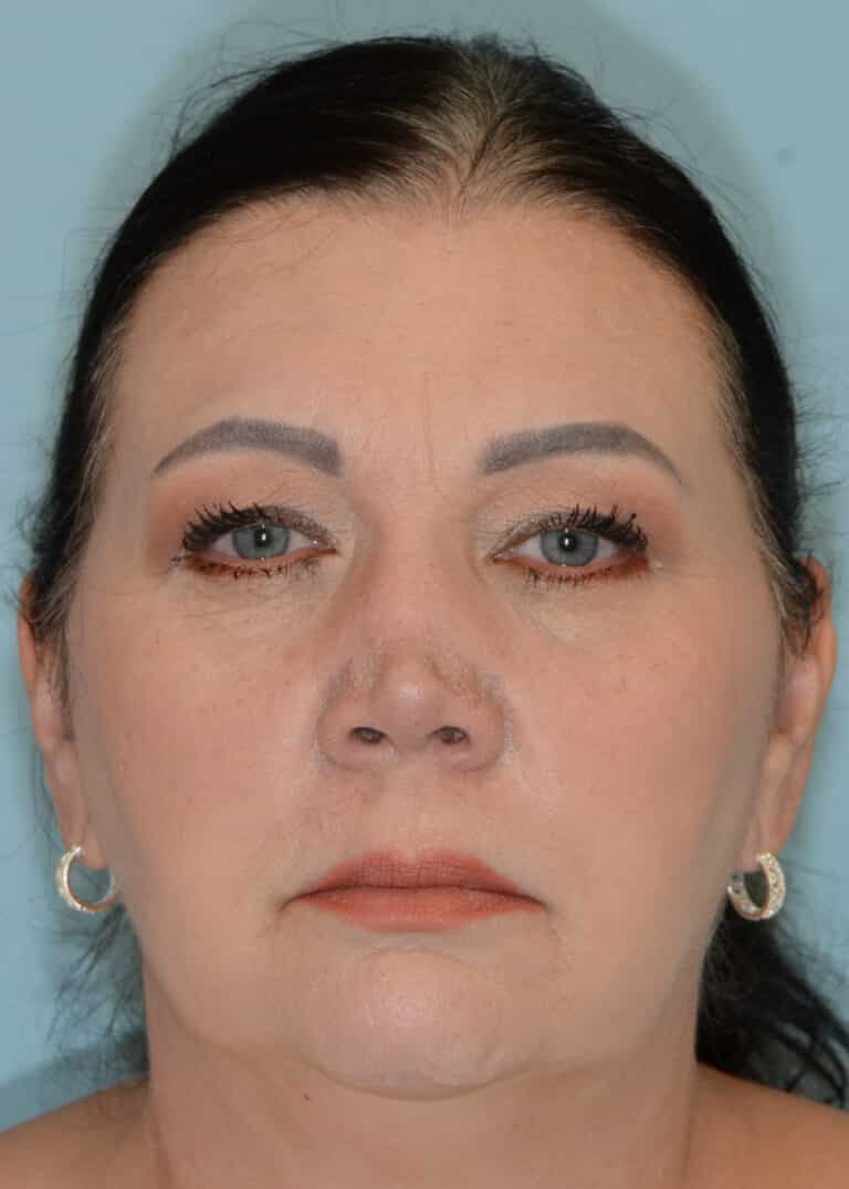 Before Image:  - front