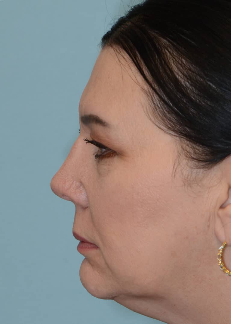 After Image:  - left-side