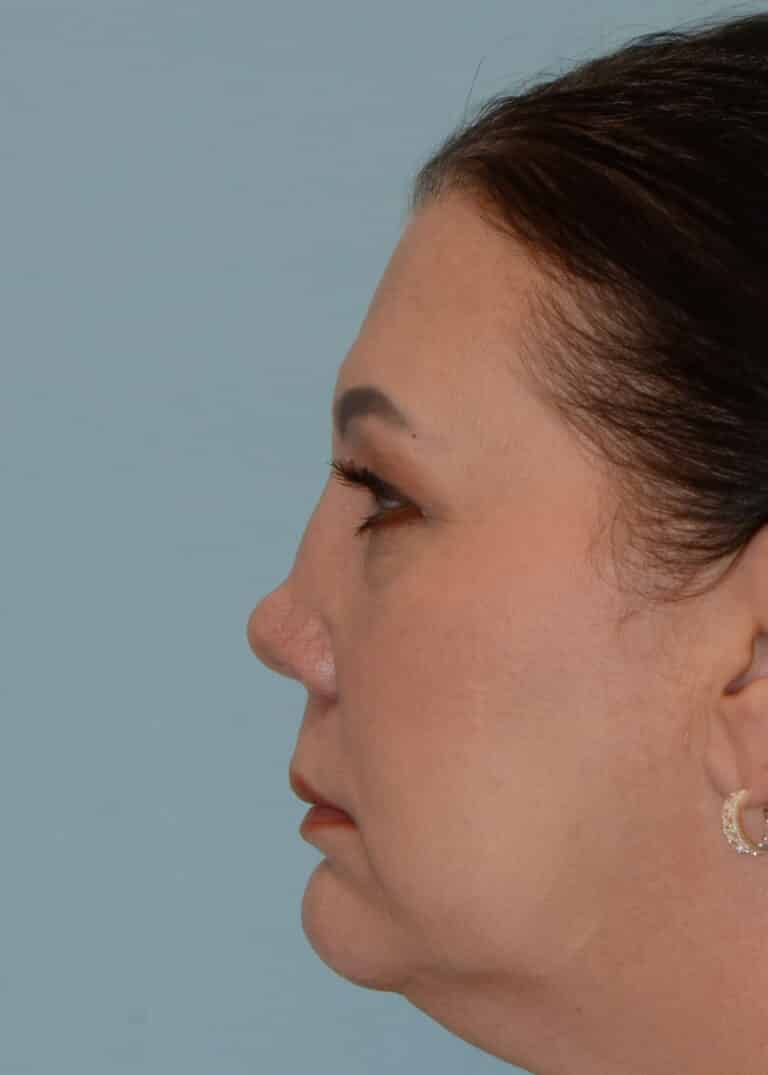 Before Image:  - left-side
