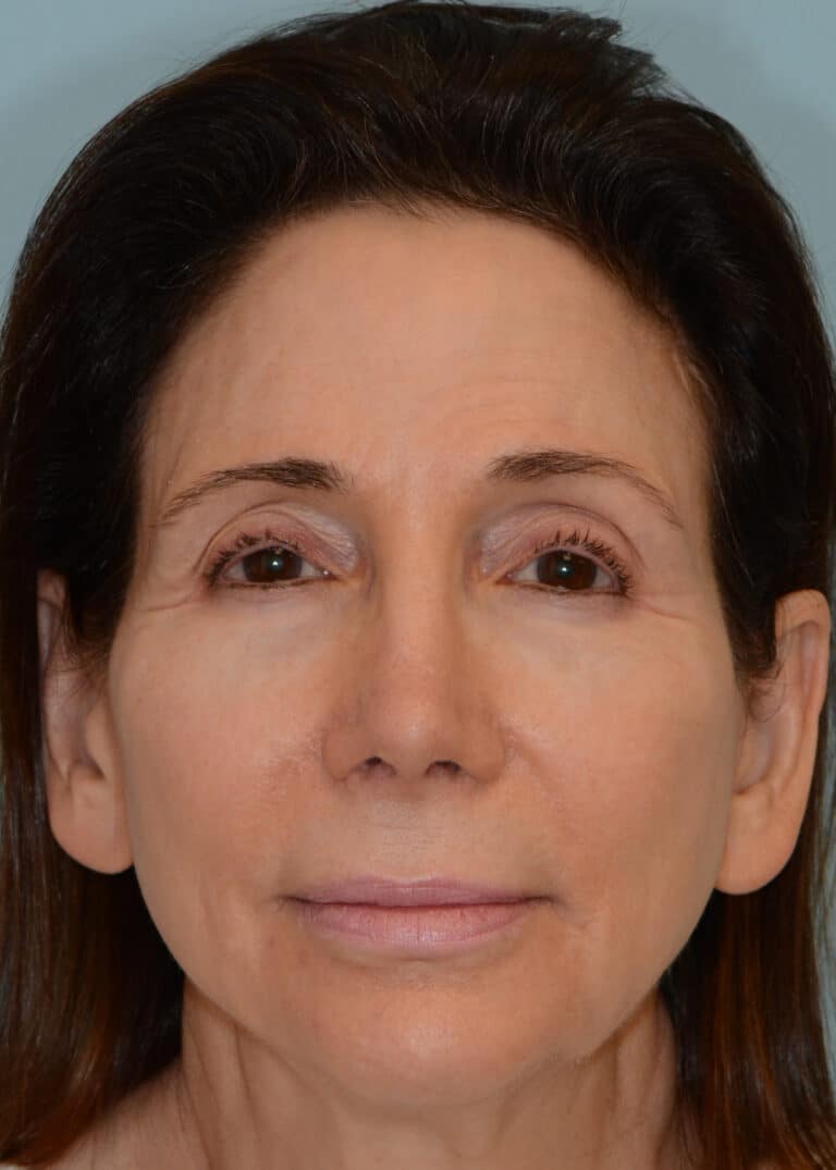 After Image:  - front