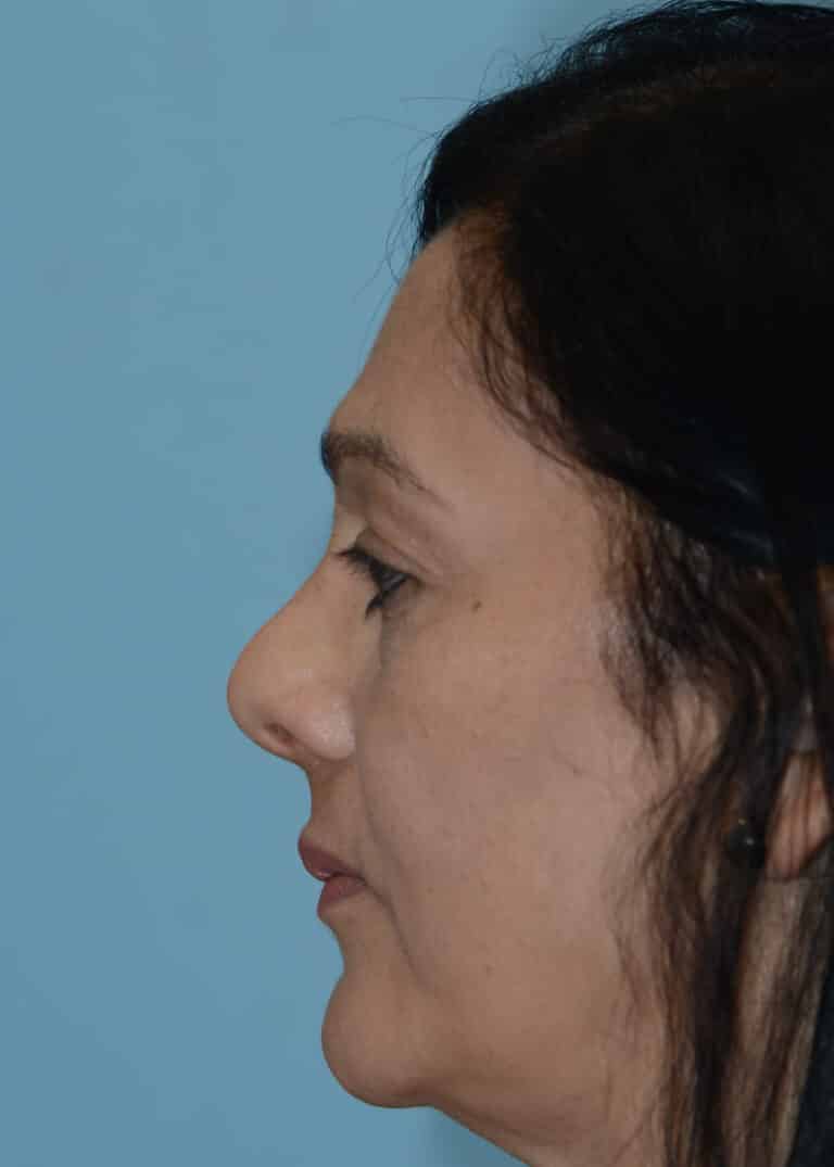 Before Image:  - left-side