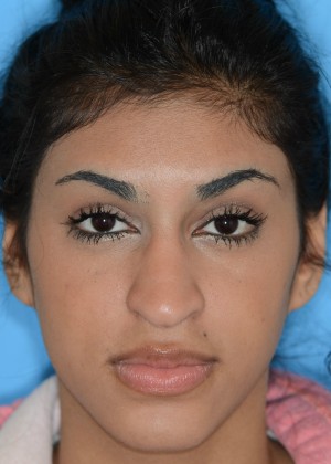 Hispanic Rhinoplasty